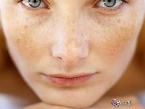 hiperpigmentacion beyourself